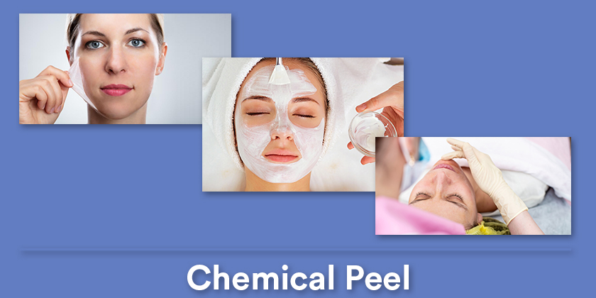 chemical-peel