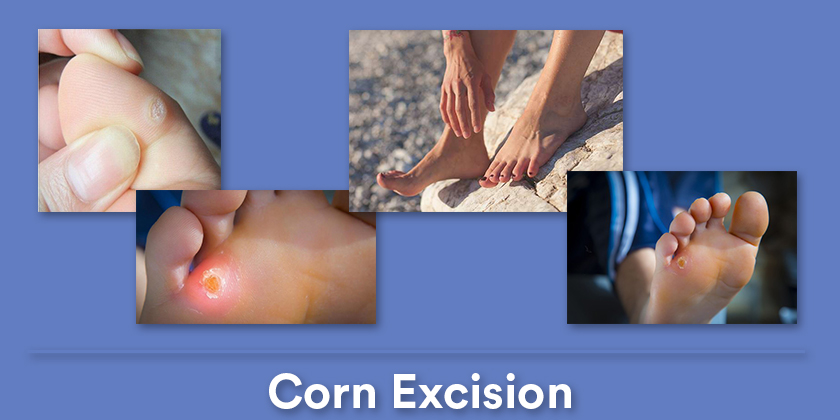 corn-excision