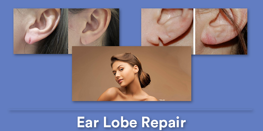 ear-lobe-repair