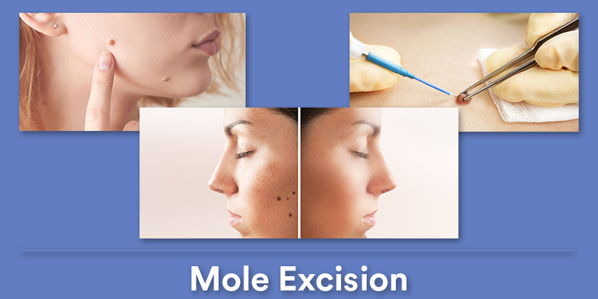 mole-excision