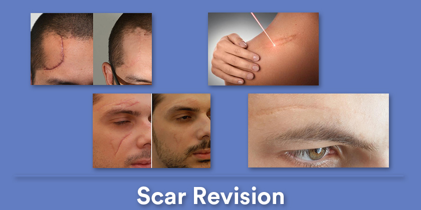 scar-revision