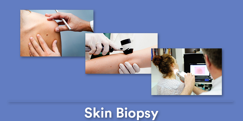 skin-biopsy