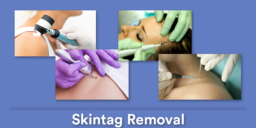 skintag-removal