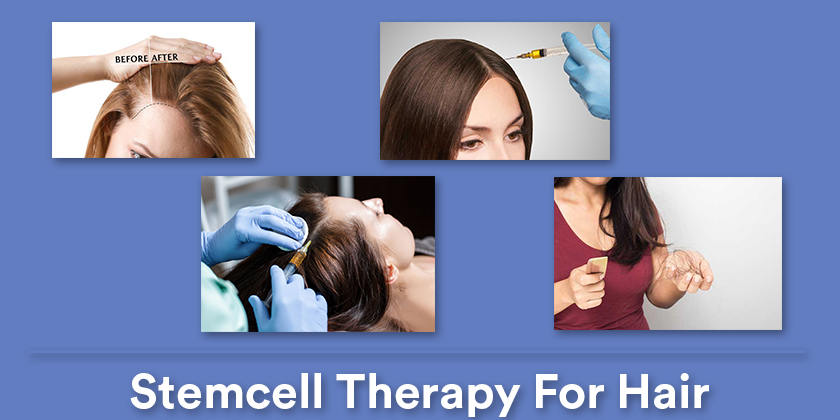 stemcell-therapy-for-hair