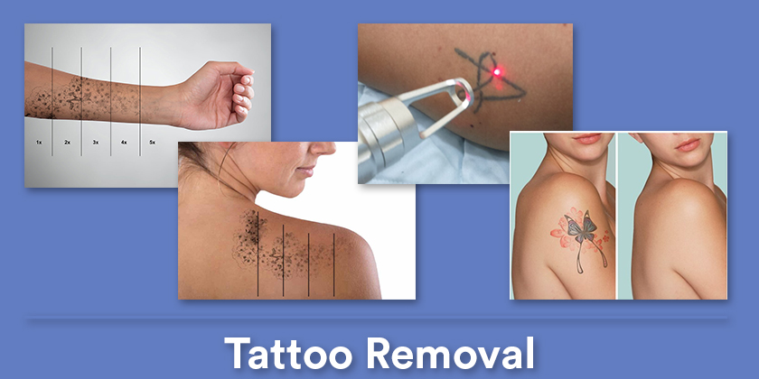 tattoo-removal