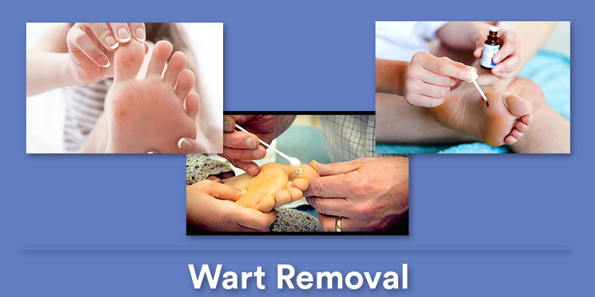 wart-removal